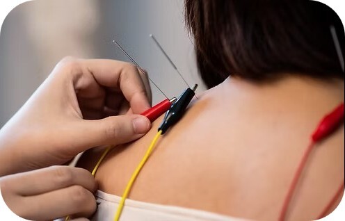 Electro-acupuncture